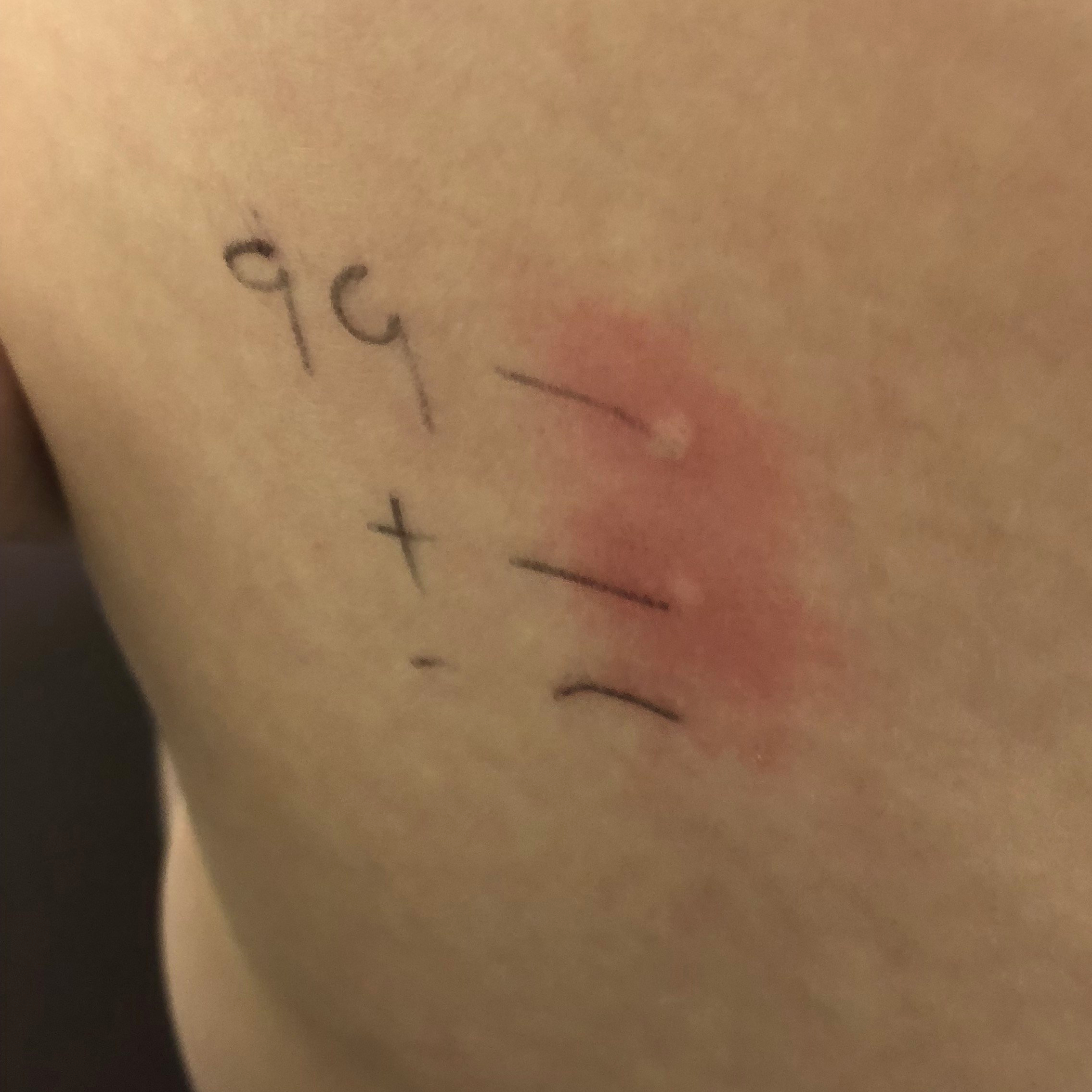 Food allergy oats Skin Prick Test