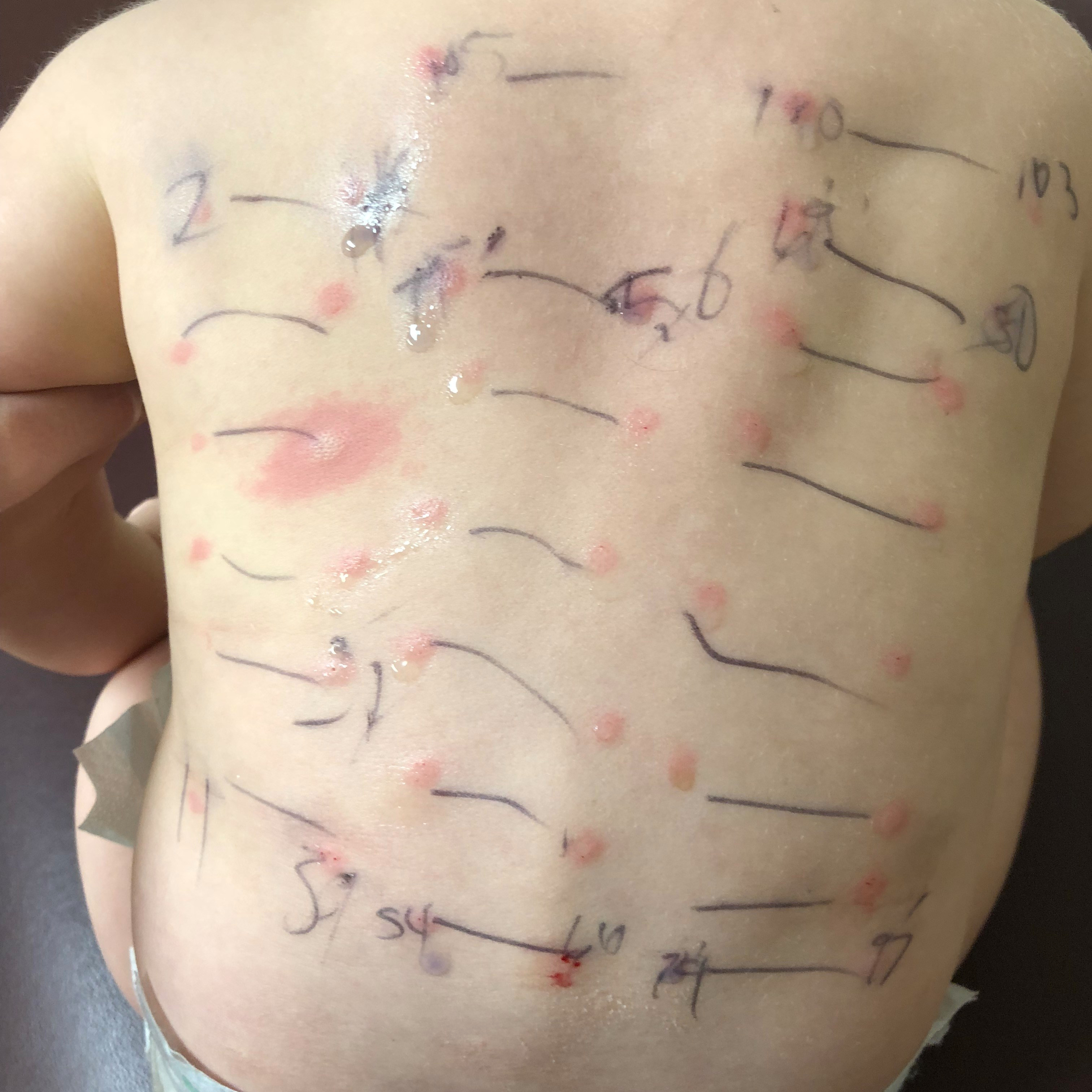 Skin Prick Test Food Allergies